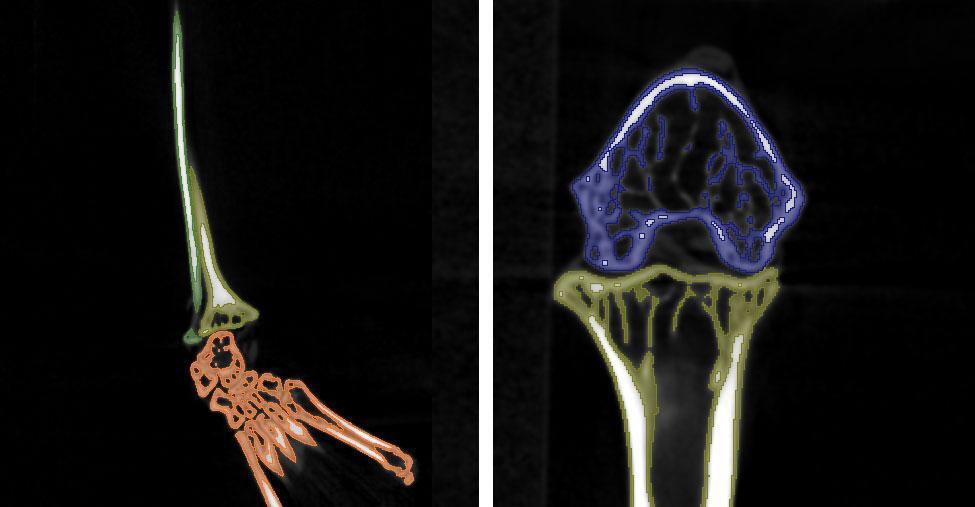 Coronal segmentation of tibia, fibula and bone of the feet and sagittal segmentation of the femur and tibia.