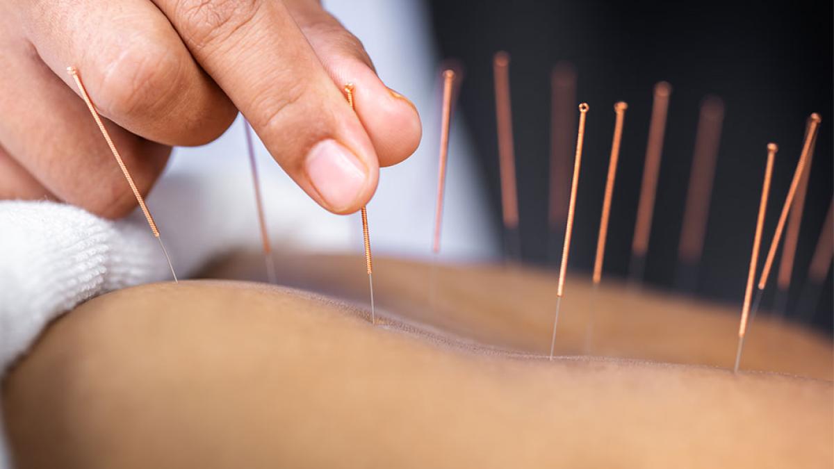 Close-up of a person receiving acupuncture.