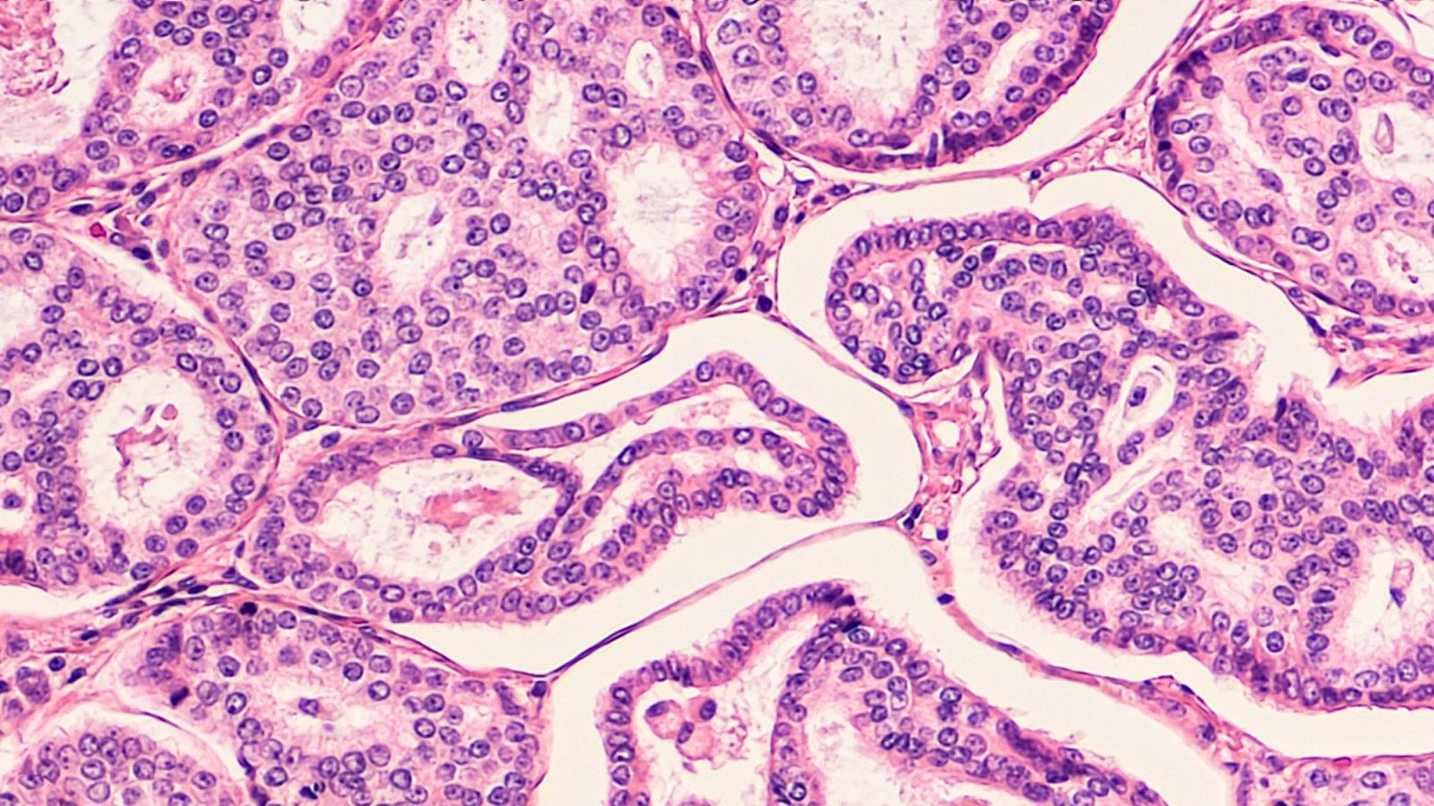 breast cancer histology